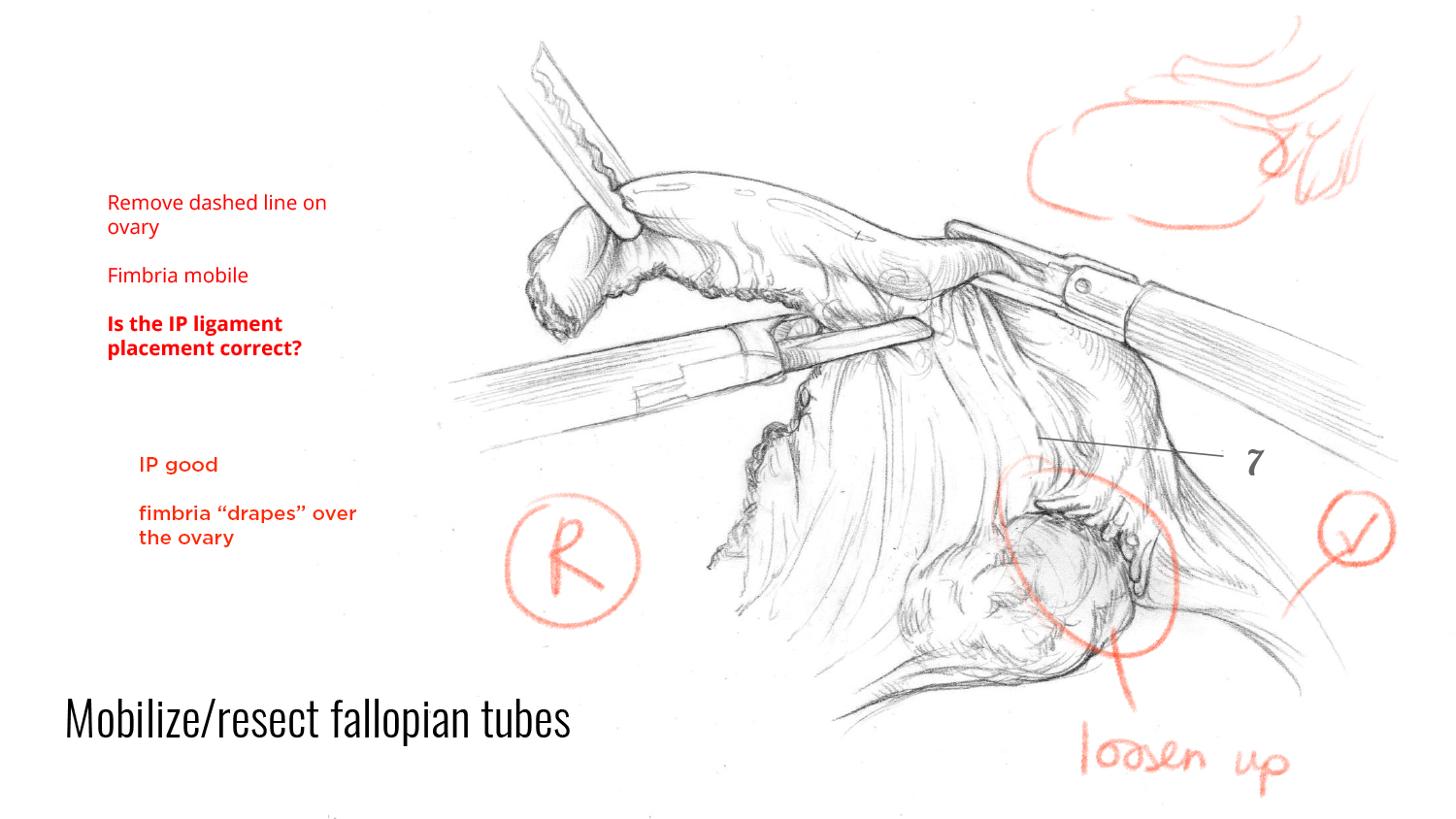 02_Fibroid Hysterectomy-9