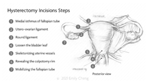 Hysterectomy slides_01_WM_01