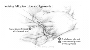 Hysterectomy slides_01_WM_02