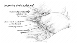 Hysterectomy slides_01_WM_03