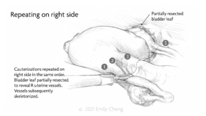 Hysterectomy slides_01_WM_04