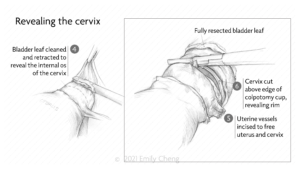 Hysterectomy slides_01_WM_05