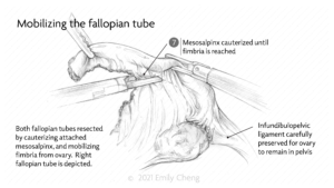 Hysterectomy slides_01_WM_06