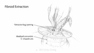 Hysterectomy slides_01_WM_08